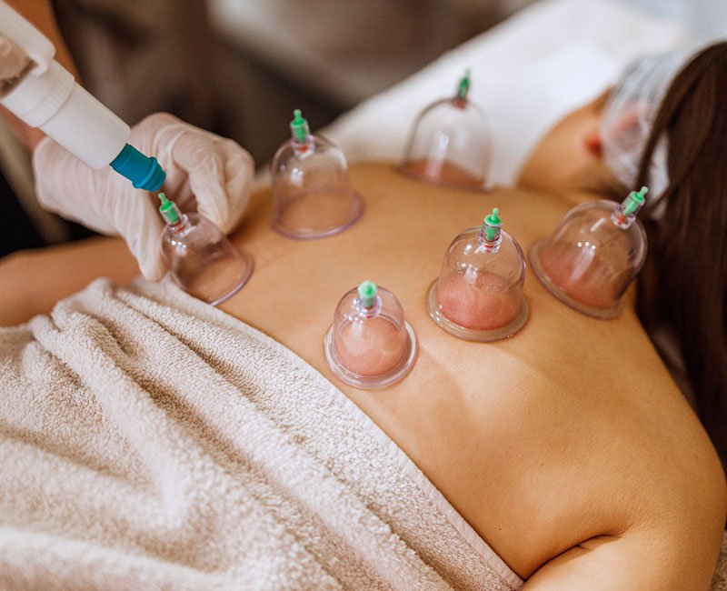 A person receiving cupping therapy treatment