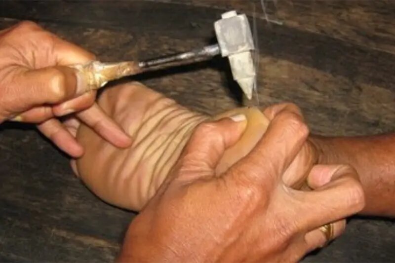A person performing Agnikarma Ayurvedic Treatment by using a needle to remove a piece of skin.