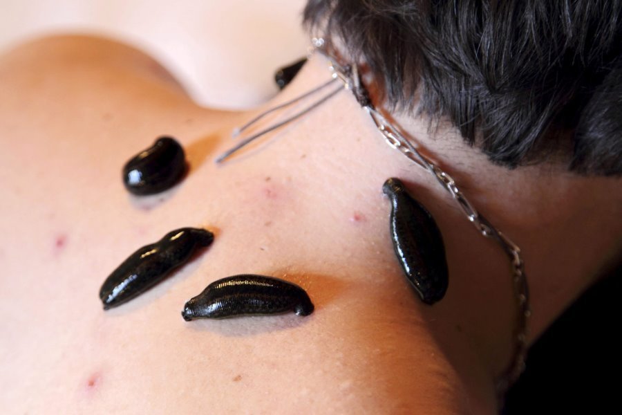 Raktamokshan Treatment