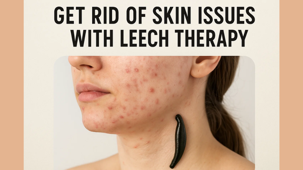 Get Rid of Skin Issues with Leech Therapy